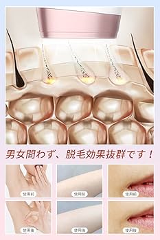 Amazon | 脱毛器 光美容器 冷感脱毛 IPL光脱毛器 全身脱毛 家庭